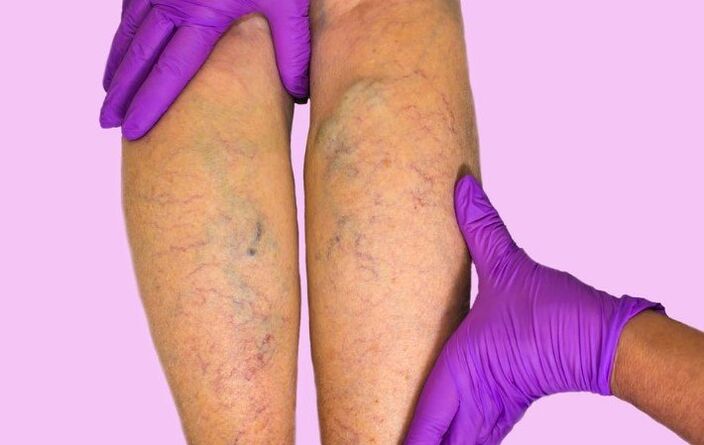 Varicose veins of lower extremities