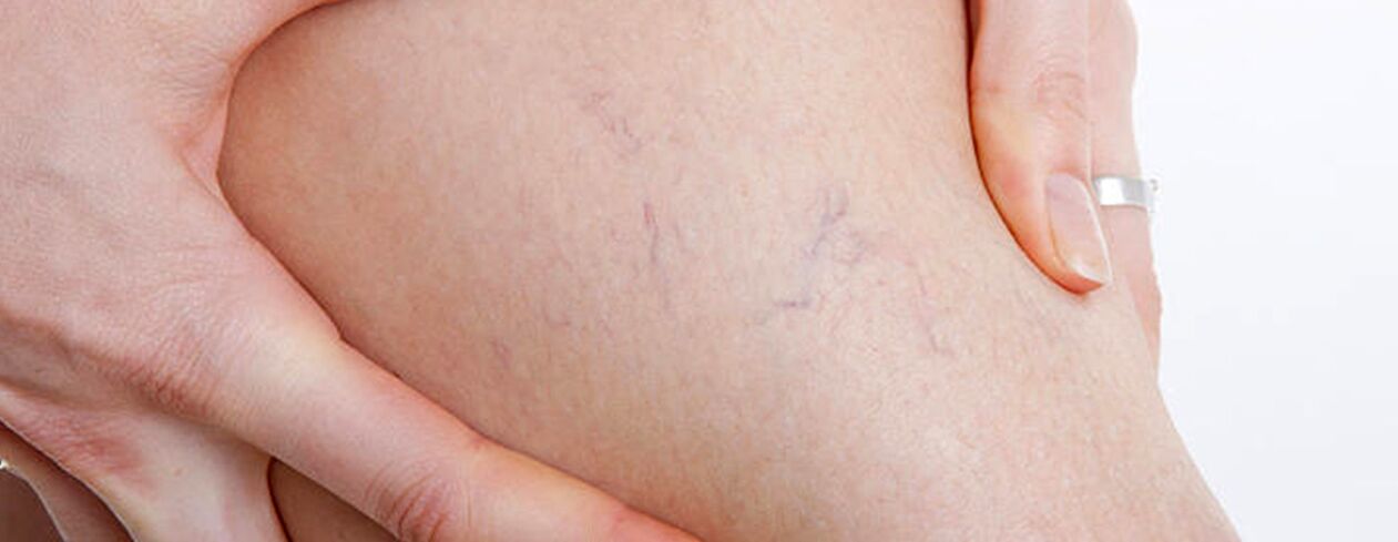 What to do about varicose veins