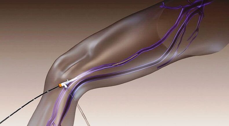 Radiofrequency Ablation - How to Treat Varicose Veins